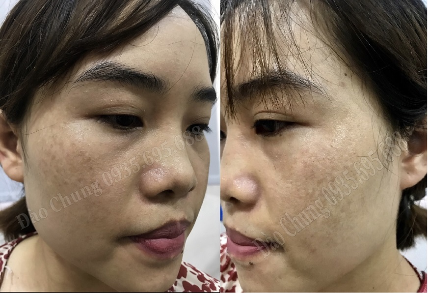 Hình Đào Chung lúc chưa điều trị